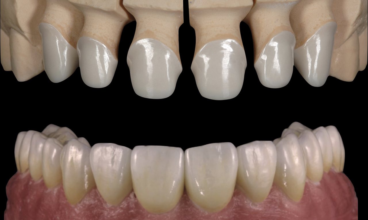 zirconia-estetica-moldavia