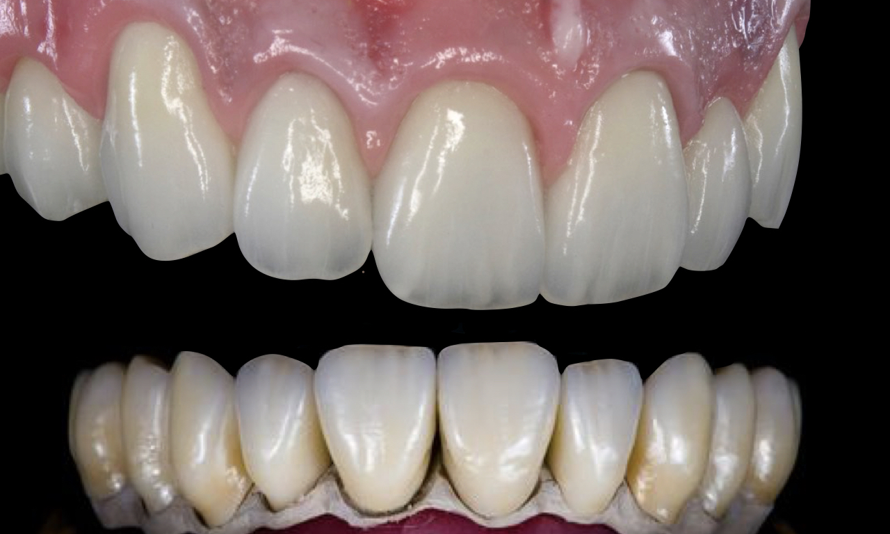 DURATA-ZIRCONIO-CERAMICA-MOLDAVIA