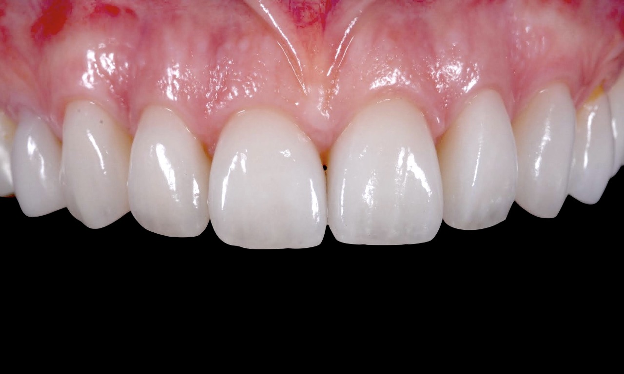 denti-zirconio-moldavia