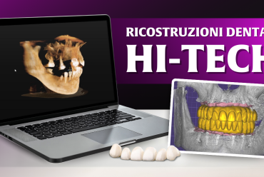 Denti fissi hi-tech: quando la bocca resta senza denti e la tecnologia fa la differenza