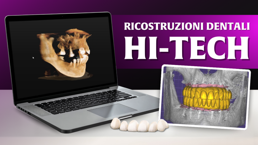Denti fissi hi-tech: quando la bocca resta senza denti e la tecnologia fa la differenza