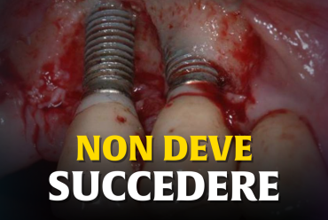 Denti fissi su impianti che si muovono o cadono, probabilmente ti hanno truffato!