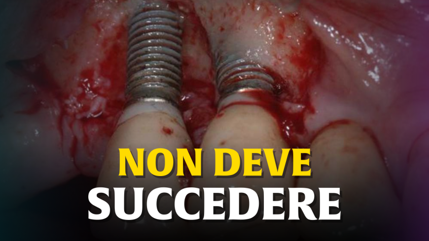 Denti fissi su impianti che si muovono o cadono, probabilmente ti hanno truffato!